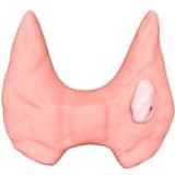 Tiroid neoplaziyaları
