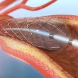 Koronar angioplastika: Ürək damarlarının yenidən açılması