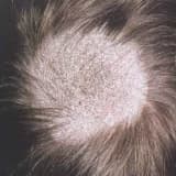 Tinea Capitis (Saçlı Dərinin Göbələyi)