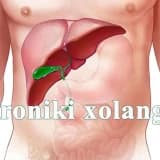 KƏSKIN XOLANGIT
