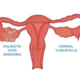 Polikistik yumurtalıq sindromu