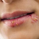 Herpes Simpleks Virusunun Səbəbləri, Simptomları və Müalicə Yolları