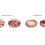 Polikistik Yumurtalıq Sindromu (PCOS): Simptomlar, Səbəblər və Müalicə
