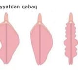 Qız uşaqlarında labial sinexiya.( Kiçik cinsiyət dodaqlarının bitişməsi)