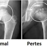 Perthes xəstəliyi haqqında