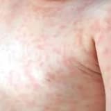 Kəmərləyici Dermatoz: Bir Dəri Xəstəliyinin Nəzərə Alınması