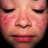 Lupus/sistemik lupus eritematosus