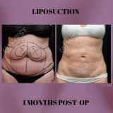 Piylərin çıxarılması (lazer lipoliz - liposaksiya)