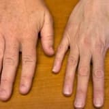 Böyümə hormonu (GH) yüksəkliyi (AKROMEGALİ)