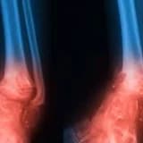 Osteomielitlərin cərrahi və konservativ müalicəsi