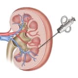 Kəskin və xroniki böyrək zədələnmələri