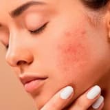 Kosmetik İstifadəyə Görə Sızanaqlar: Acne Cosmetica və Qarşısının Alınması