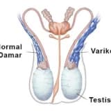 Varikosel nedir