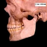 Temporomandibular Eklem (TMJ) xəstəliyi: