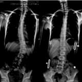 Skolyozda braket müalicəsi
