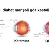 Şəkərli diabet və hipertonik retinopatiyalar