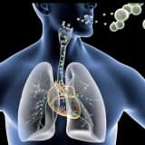 Alveolyar proteinoz nədir?