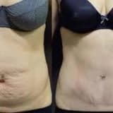 Abdominoplastika: Daha Sağlam və Estetik Qarın Profilinə Səyahət