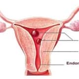 Uşaqlıq boynunun patologiyaları (eroziya, polip, endometrioz)