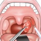 Tonsillotomiya nədir?