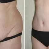 Qarın gərmə - Mini Abdominoplastika, Tam Abdominoplastika, Full Abdominoplastika body plastika