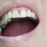 Dişlərin bərk toxumalarının hər növ terapiyası