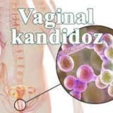 Vaginal kandidoz