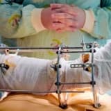 Boy uzatma əməliyyatları haqqında