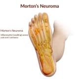 Morton neyroması
