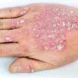 Pullu dəmrov (Psoriaz) haqqında