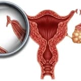 Ginekoloji erkən diaqnoz