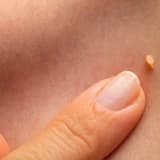 Ziyil (HPV virusu)