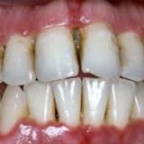 İltihablı dişlərin müalicəsi və s.