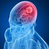 Beyin Şişləri: Tərif, Səbəbləri və Müalicə Yolları