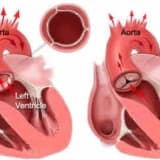 Aorta çatışmamazlığı və darlığı