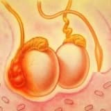 Orxoepididimit