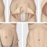 Reverse Abdominoplastika:Abdominoplastika əməliyyatını necə geri qaytarmaq olar