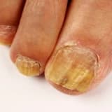 Qaraquş (Dırnaq Mayası): Təsirləri və Müalicə Yolları