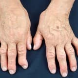 Revmatoid artrit nədir?