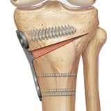 Osteotomiya