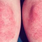 Dermatomiozit