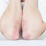 Lupus / sistemik lupus eritematosus