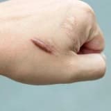 Keloid haqqında