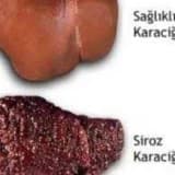 Qara ciyər sirrozu