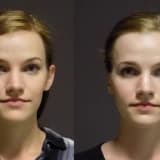 Otoplastika: Estetik və İnkişaf