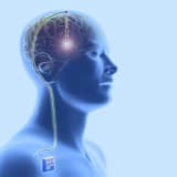 Beyin Stimulyatoru: Nevroloji Pozğunluqlara Yeni Bir Yanaşma