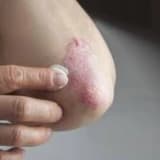 Psoriaz (Dəmrov)
