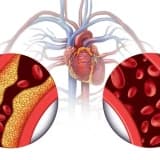 Yüksək Qan Xolesterol və Triqliserit: Sağlamlığımız üçün Niyə Əhəmiyyətlidir?