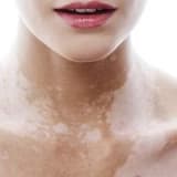 Vitiligo haqqında