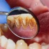 Parodontitin müalicəsi